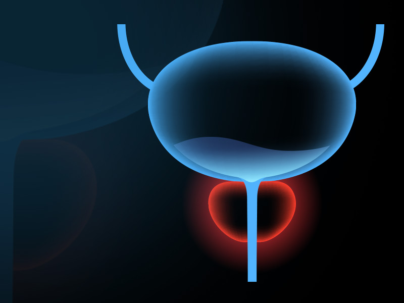 Incontinência urinária após cirurgia de próstata: é normal? Tem solução?